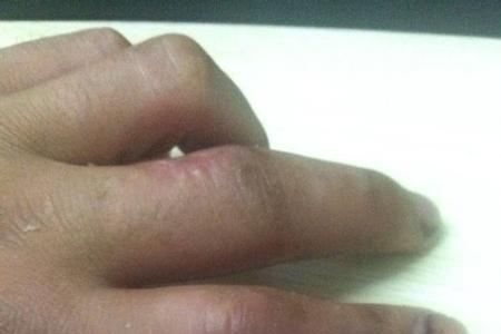 手掌受伤能评几级伤残