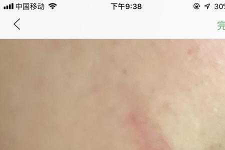 男生会不会介意女生脸上有疤痕