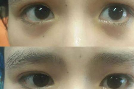 女人眼袋发黑是出轨吗