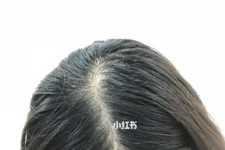 如何生发增加头发量学生党