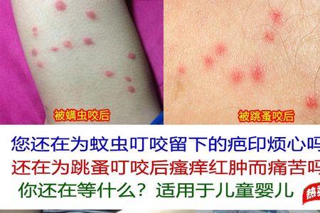 被臭虫咬了衣服要丢吗