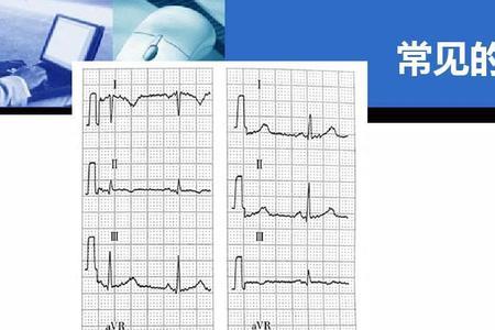 ecg的测量参数是什么