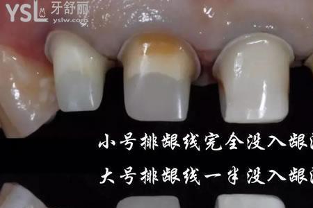 全瓷牙的色号哪个最自然