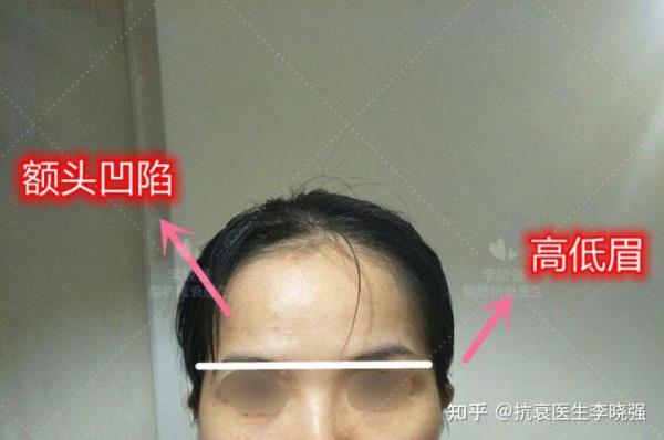 青春期眉骨可以变高吗