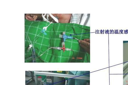 picco导管连接方法