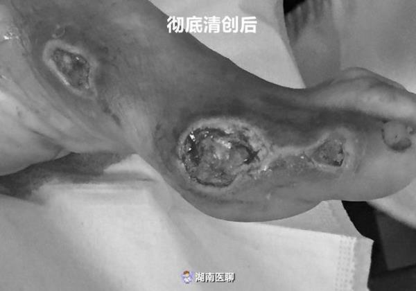 脚掌截肢属于伤残几级