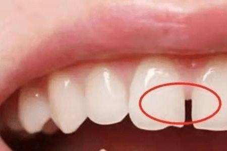 做的陶瓷牙用牙签能插到底部