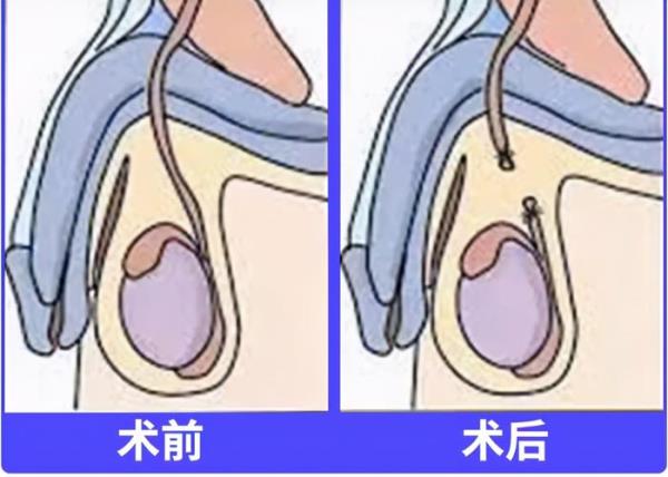 男人结扎后对夫妻的影响