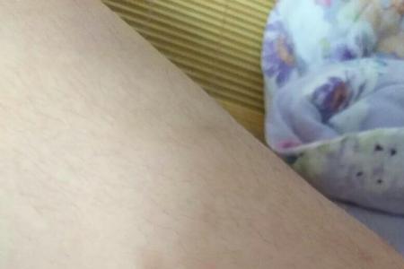 犬类抓痕是什么样的