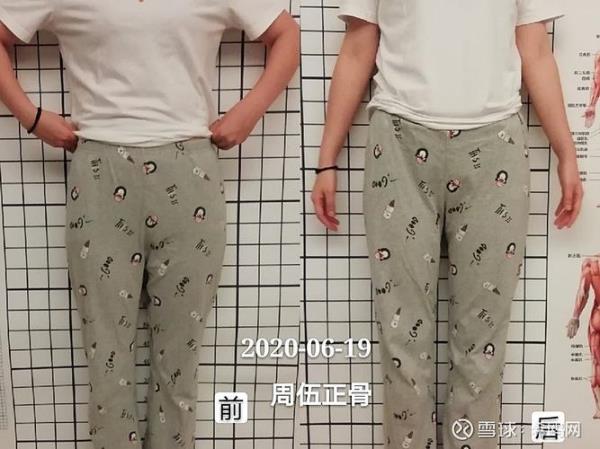蝶骨取出来了还能装上去吗