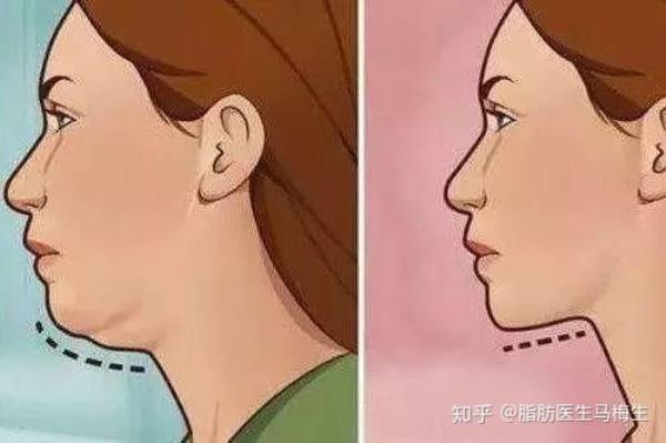 有下巴和没下巴的区别的图片