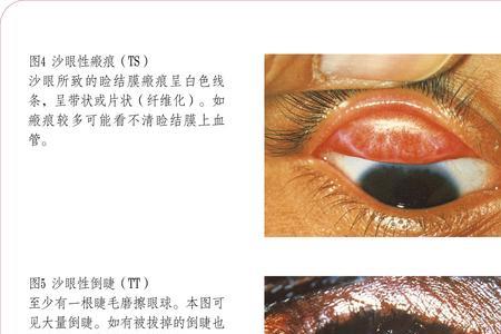 什么是砂眼
