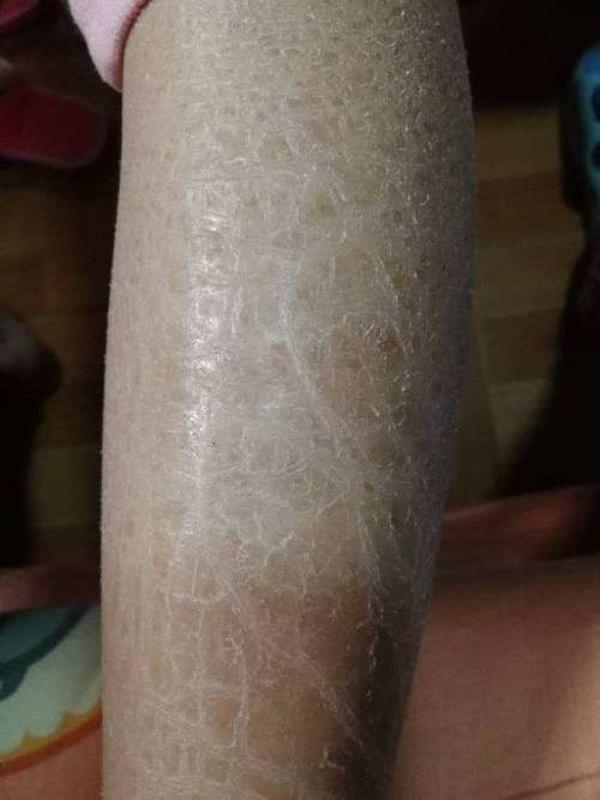 皴裂和皲裂的区别读音