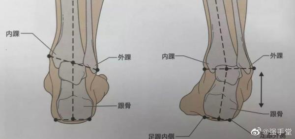 后足力线的正确摆放