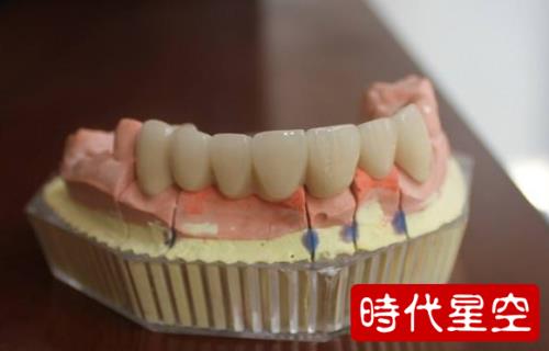烤瓷牙需要多久才换一次
