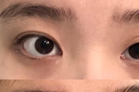 眼神纠正是什么项目