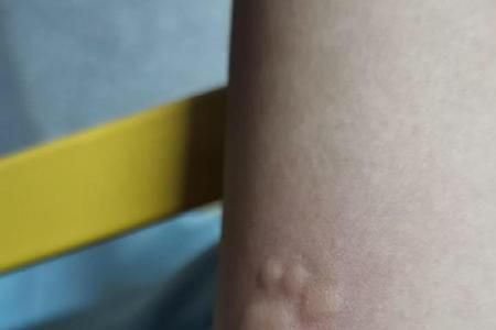 男生说被蚊子咬了什么意思
