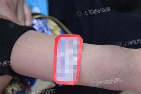 贝壳痣为什么长毛