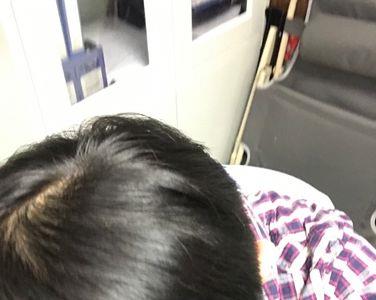 头顶旋的正常发量