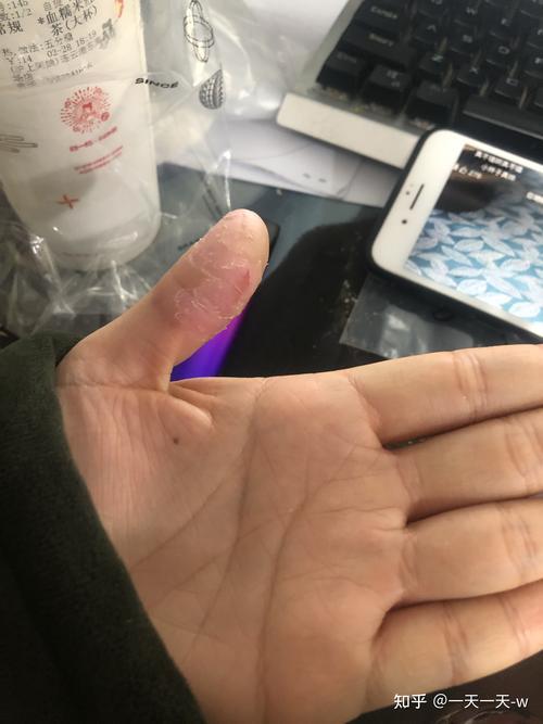 撕手皮是什么心理