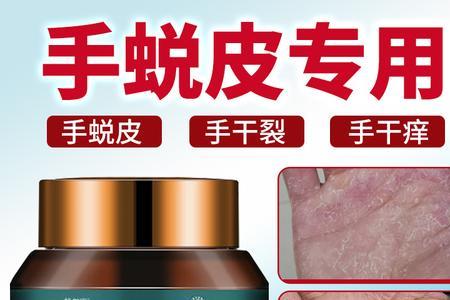 人褪皮和蜕皮区别