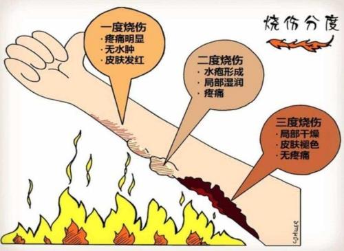 被100度开水烫到为什么没事