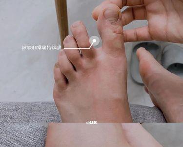 蚂蚁咬脚寓意什么
