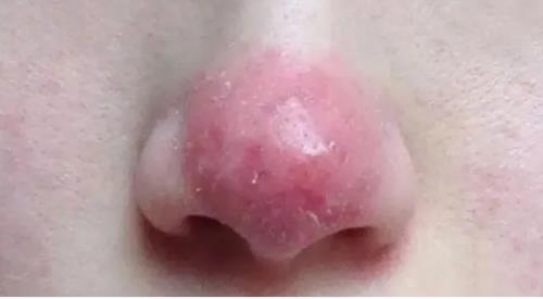 草莓鼻清理过程