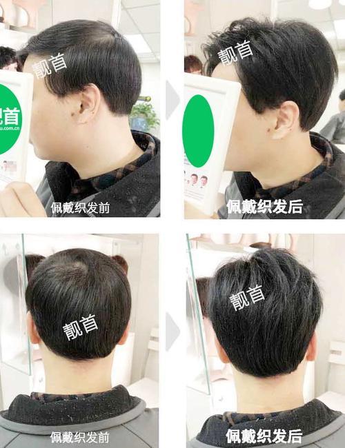 织发补发最新技术