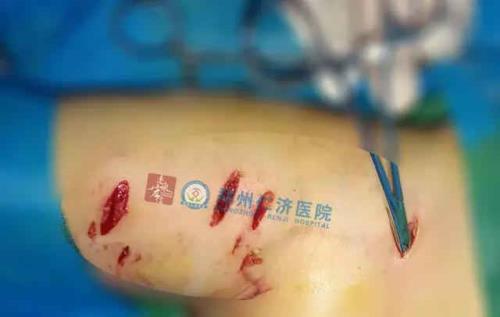 被别人的狗咬了医保可以报销吗