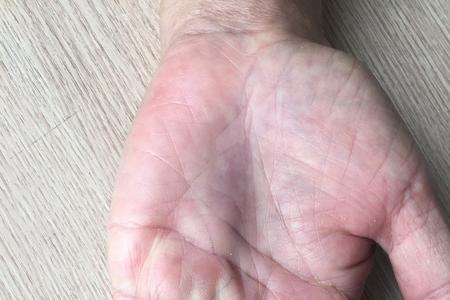 左手尾指发麻是什么原