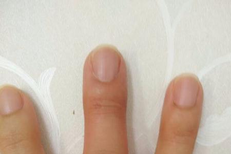 右手中指写字鼓包怎样消除
