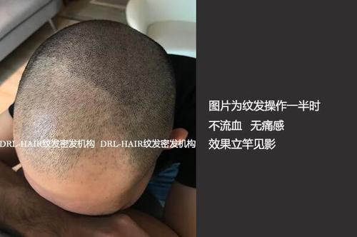 光头可以纹成黑色吗