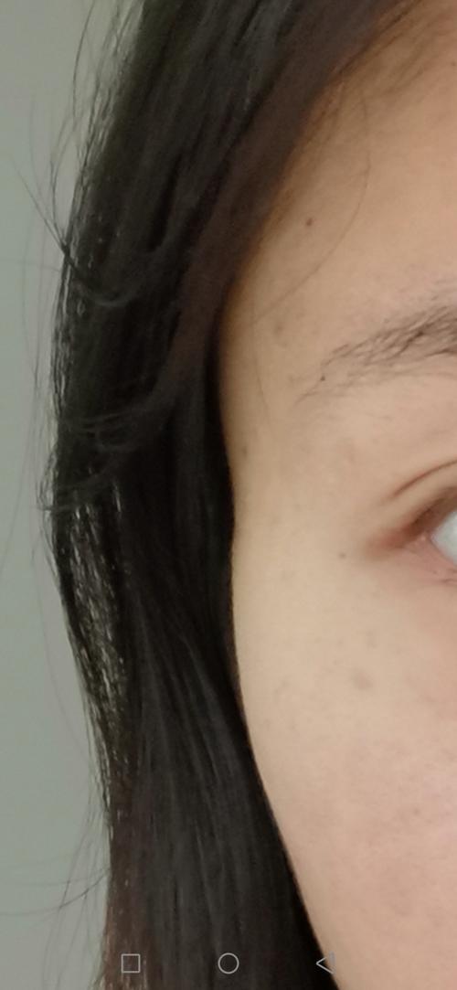 戴眼镜脸部变形怎么恢复