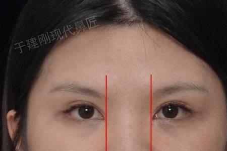缩鼻孔和缩鼻翼的区别