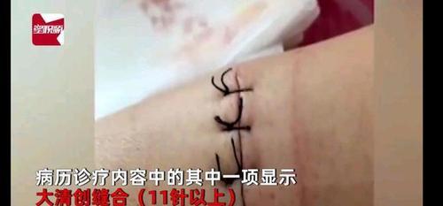 伤口缝了11针构成几级伤残