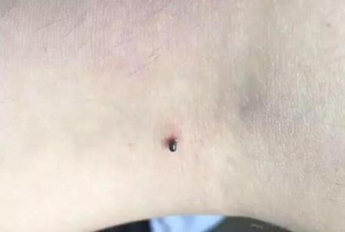 乌鸦蜱虫清除过程