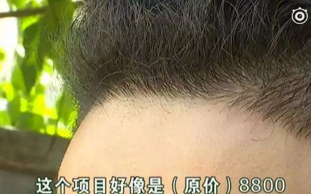 发际线鬓角怎么算正常
