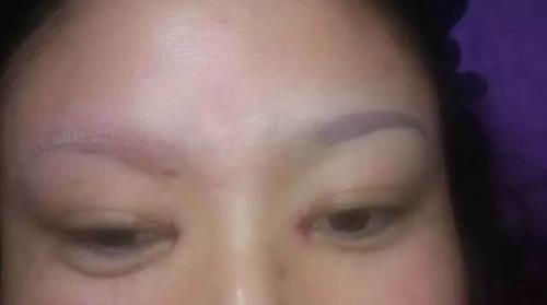 激光洗眉毛之后为啥颜色会变深