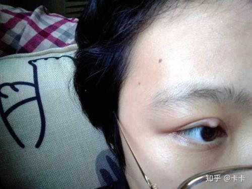长针眼系红绳方法