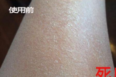 溶解角质是什么意思