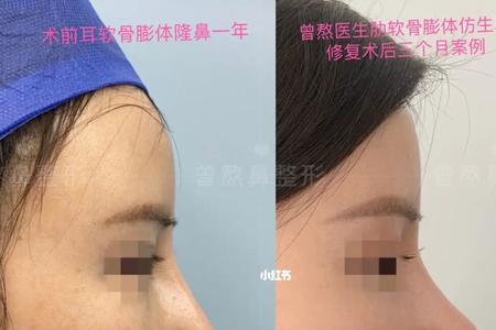 睿智鹰钩鼻可以变成小翘鼻吗