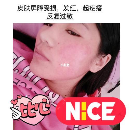 女生脸过敏男生怎么安慰