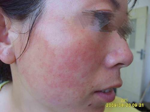 脸上有红斑怎么化妆