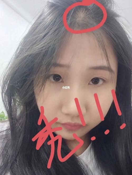 刘海中间秃了怎么办