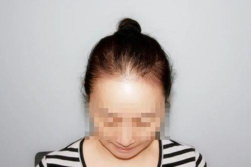 把头发往后拔发际线会变高吗