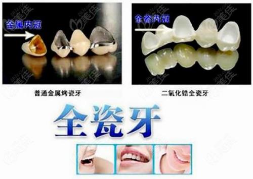 400元一颗的烤瓷牙是什么质量