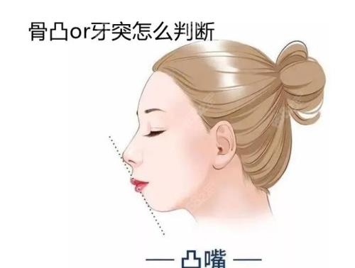 凸牙怎么笑好看