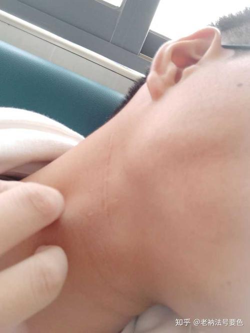 缝四针算轻伤吗