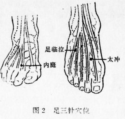 什么是中三针